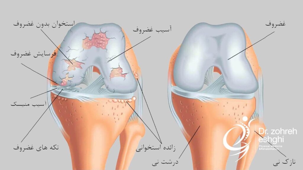 آسیب های غضروف