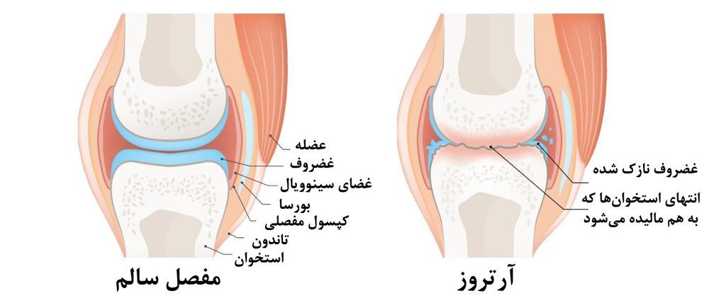 استئوآرتریت (آرتروز)