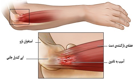 استرین