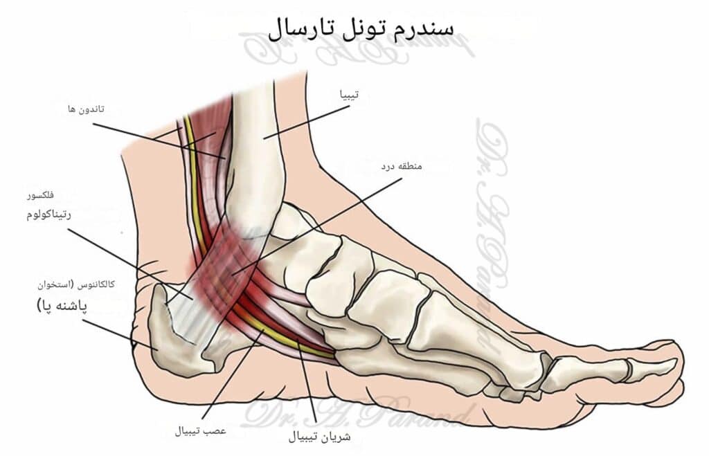 التهاب تاندون آشیل و کیسه زلالی تاندون آشیل