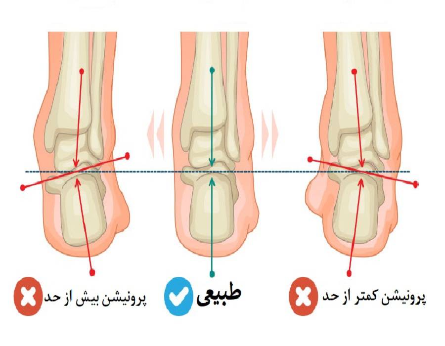 انحراف پا