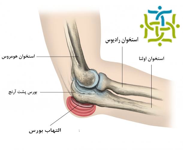 تورم کیسه زلالی یا بورسیت ارنج