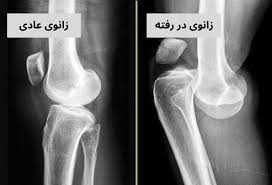 دررفتگی( (dislocation