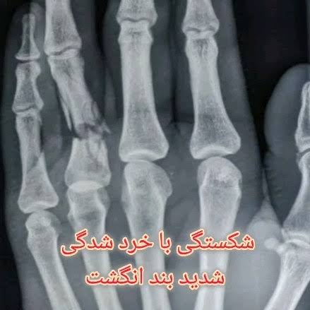 شکستگی بند انگشت