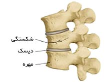 شکستگی و جابجایی ستون مهره