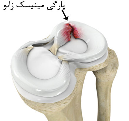 علائم پارگی مینیسک
