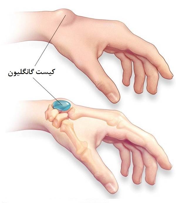 فتق مچ دست یا کیست گانگلیون