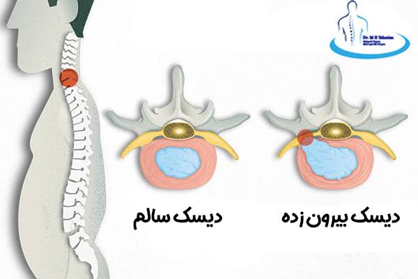 فتق یا هرنی دیسک