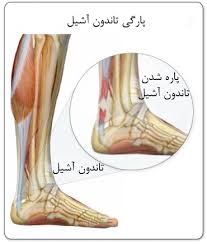 پارگی تاندون آشیل