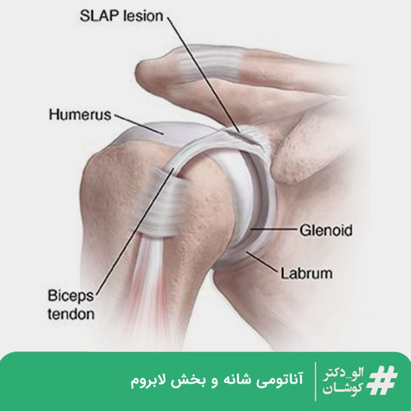 پارگی لابروم یا غضروف شانه