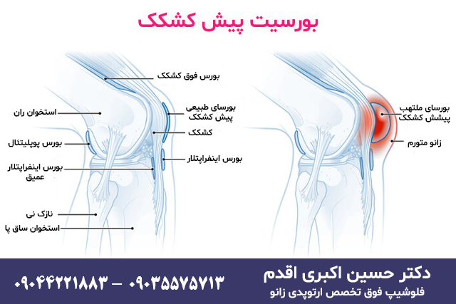 آسیب کیسه زلالی یا بورسیت
