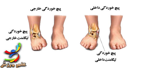 اسپرین مچ پا