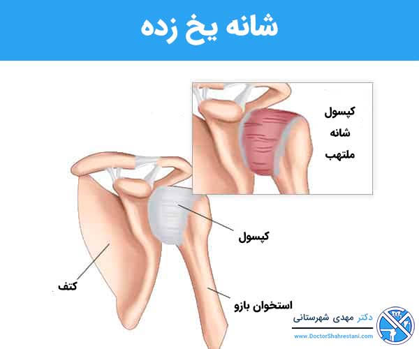 شانه یخ زده