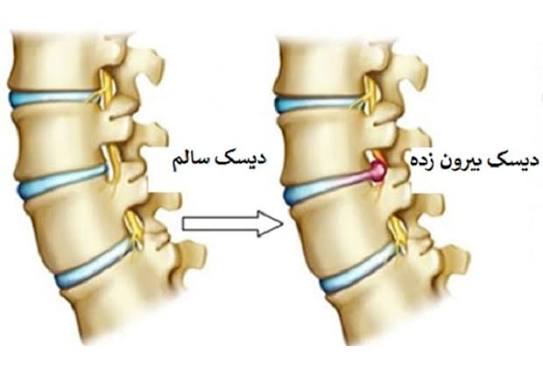 فتق یا هرنی دیسک