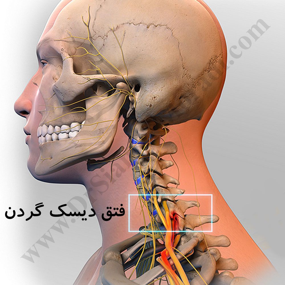 فتق یا هرنی دیسک