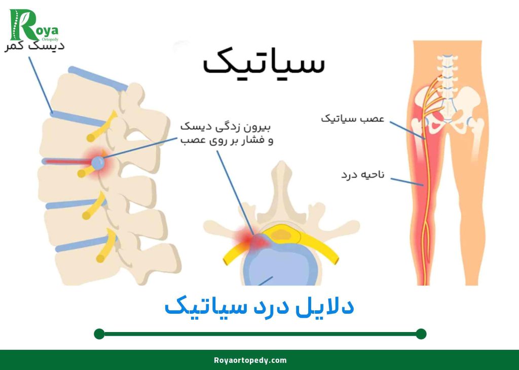 فتق یا هرنی دیسک